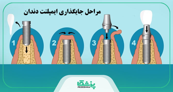 قیمت ایمپلنت دندان در سال 1404 + جدول هزینه انواع برندها【سال1404】 قیمت ایمپلنت دندان در سال 1404 + جدول هزینه انواع برندها【سال1404】