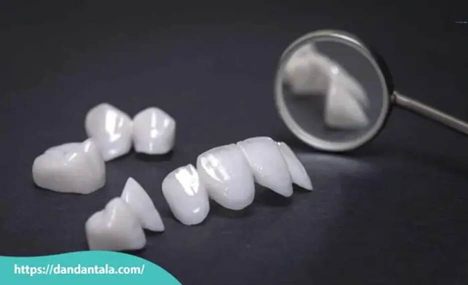 فرق لمینت و کامپوزیت کدام بهتر است؟ فرق لمینت و کامپوزیت کدام بهتر است؟