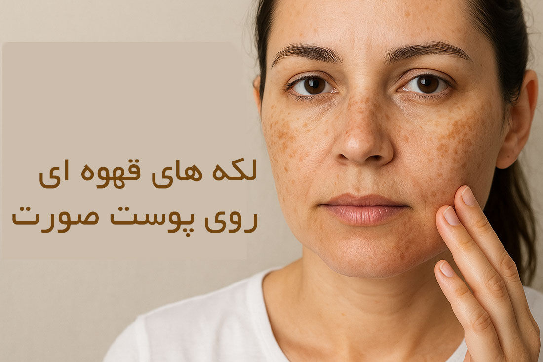 لکه های قهوه ای روی پوست صورت نشانه چیست؟ لکه های قهوه ای روی پوست صورت نشانه چیست؟