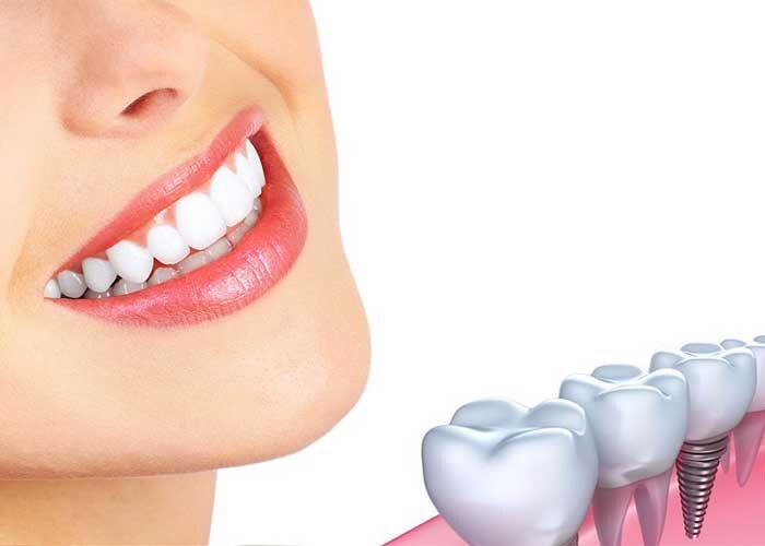 درباره علل و مدت زمان درد ایمپلنت دندان بیشتر بدانید

