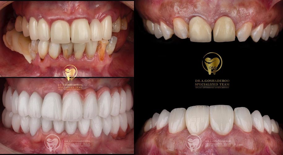 روکش زیبایی لمینت