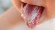 درمان های خانگی برفک دهان