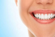 لمینت دندان روشی نوین در دندانپزشکی
