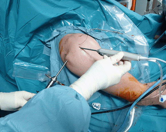 مزایای نوع عمل جراحی آرتروسکوپی شانه