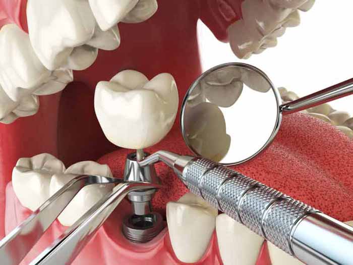 لمینت دندان روشی نوین در دندانپزشکی