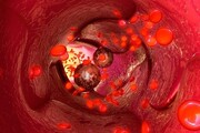 لیپوپروتئین ریسک ابتلا به سرطان پروستات را افزایش می دهد