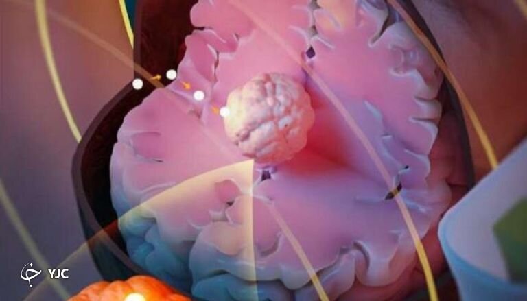 درمان سرطان