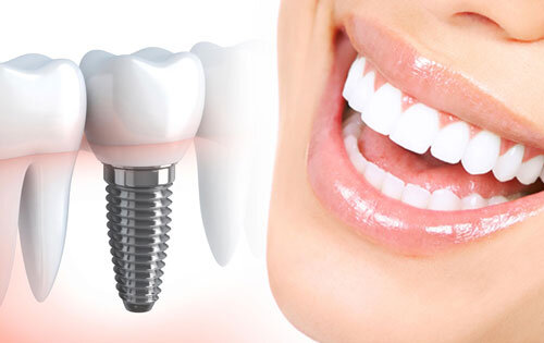 هر آنچه باید در مورد ایمپلنت دندان بدانید !
