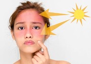 درمان آفتاب سوختگی با گیاهی شیرین