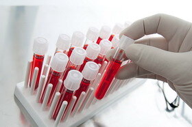 درمان گران اچ‌آی‌وی با پیوند سلول‌های بنیادی