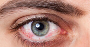۶ عفونت‌ چشمی که می‌توانند عواقب فاجعه‌باری داشته باشند