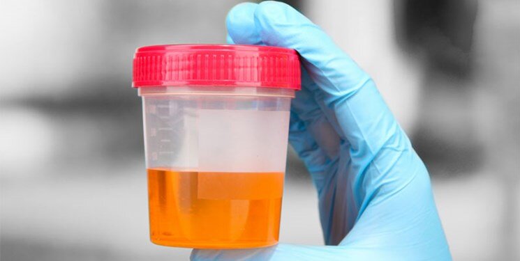 وجود خون در ادرار را جدی بگیرید! وجود خون در ادرار را جدی بگیرید!