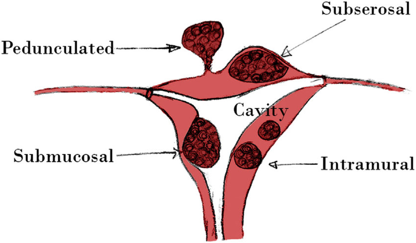 فیبروم، روشهای تشخیص و درمان
