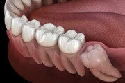 هر آنچه باید از دندان عقل بدانید