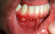 علل بروز آفت‌های دهانی