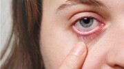 علل بروز عارضه چشم صورتی و راه‌های درمان آن