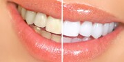 انواع روشهای سفید کردن دندان ها