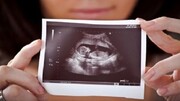 سرنوشت غربالگری جنین در دست وزارت بهداشت است؟