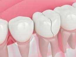 چگونه دندان قروچه را ترک کنیم؟