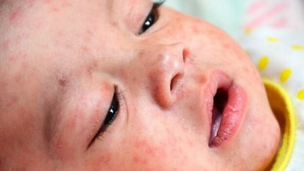 علائم "سرخک" و اهمیت واکسیناسیون کودکان در موعد مقرر