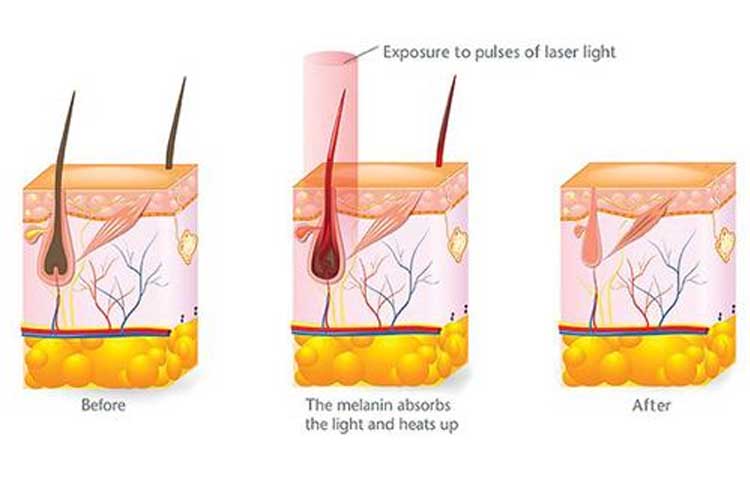 آیا لیزر موهای زائد باعث نازایی میشود؟
