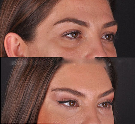 ایجاد زیبایی در چهره به عنوان یکی از مزایای انجام لیفت شقیقه