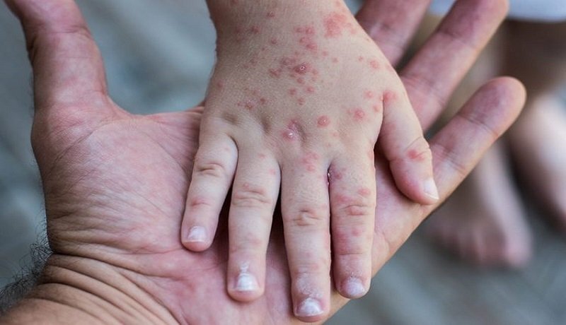 بیدار شدن سرخک از خواب زمستانی  بیدار شدن سرخک از خواب زمستانی