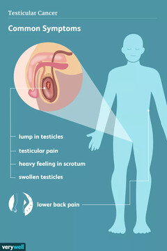 testicular-cancer-symptoms1-5b2190e41d64040037c9891a.webp