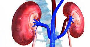 برای پیشگیری از عود سنگ کلیه چه کنیم؟ برای پیشگیری از عود سنگ کلیه چه کنیم؟