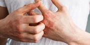 سونامی آلرژی در راه است!/ مشکلات پوستی پساکرونا چیست؟