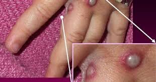 "آبله میمونی" همهگیر میشود؟ "آبله میمونی" همهگیر میشود؟