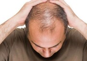 یک عامل تشدیدکننده ریزش مو درمردان