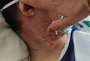 ضرب و جرح بیمار سندروم داون در مرکز توانبخشی