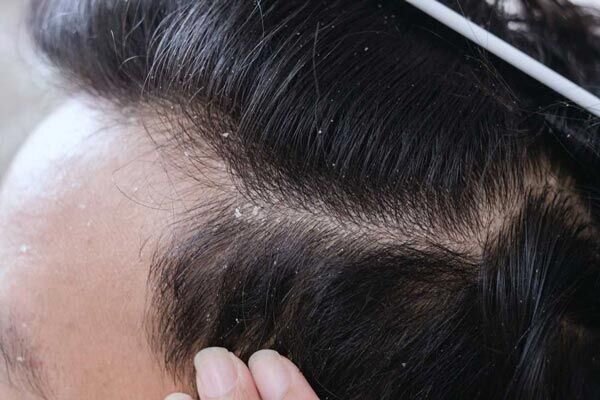 علت اصلی ایجاد شوره روی پوست سر چیست؟