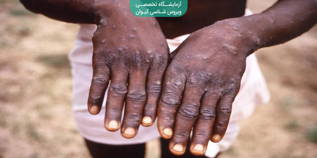 آیا آبله میمون به ایران رسیده؟ آشنایی با علائم و درمان آن