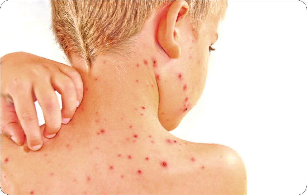 آبله میمونی قابلیت تبدیل شدن به «پاندمی» را دارد؟ آبله میمونی قابلیت تبدیل شدن به «پاندمی» را دارد؟