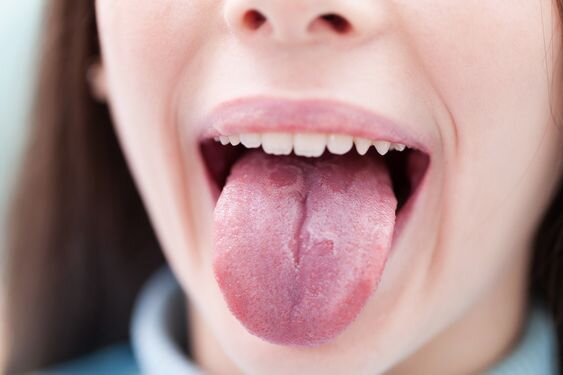 درمان های خانگی برای سوختگی زبان 
