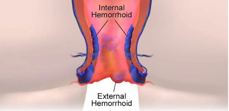 برای درمان بواسیر چه باید کرد؟
