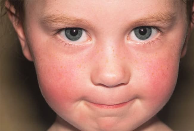 عکس/ مشکلات شایع پوستی در کودکان