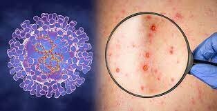 مورد آبله میمونی در کشور تایید نشده است مورد آبله میمونی در کشور تایید نشده است