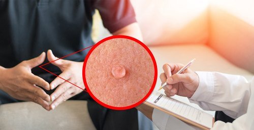اقدامات مورد نیاز هنگام ابتلا به زگیل تناسلی اقدامات مورد نیاز هنگام ابتلا به زگیل تناسلی