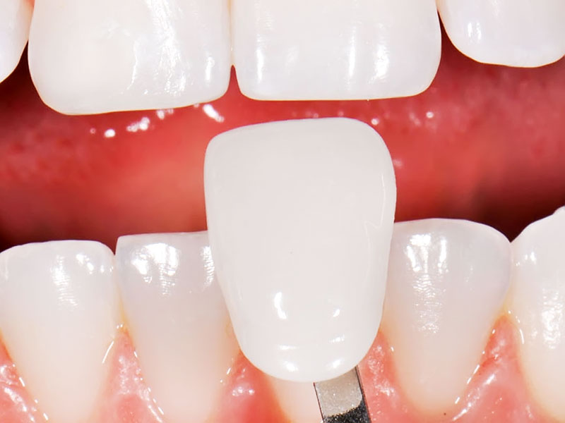 همه چیز درباره لیمنت دندان