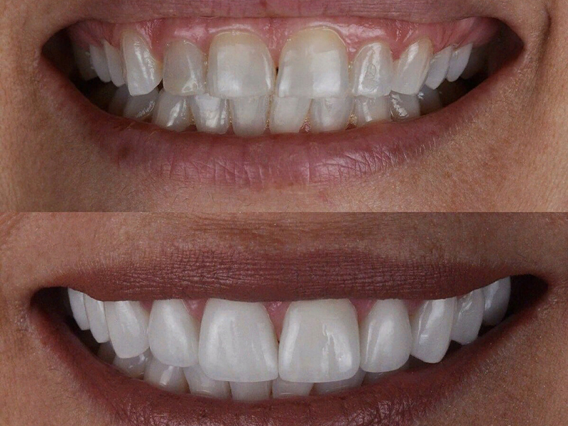 همه چیز درباره لیمنت دندان