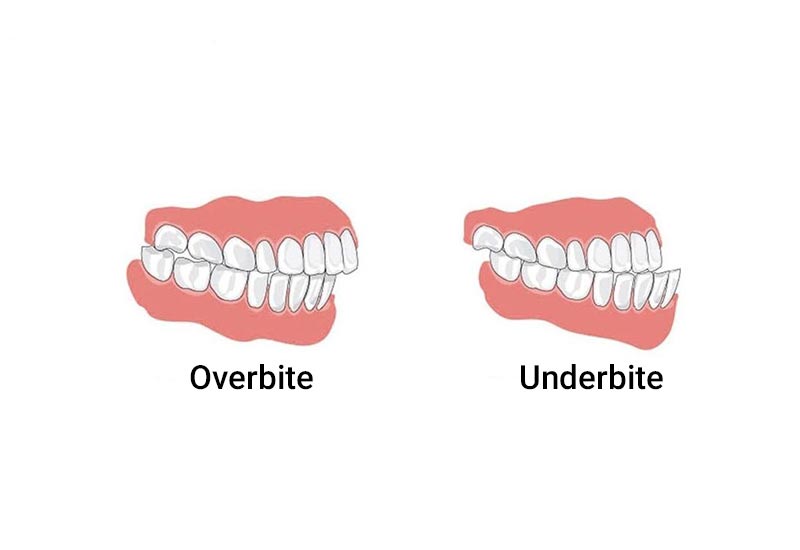 ارتودنسی نامرئی فقط این نامرتبی های دندان را برطرف می کند؟