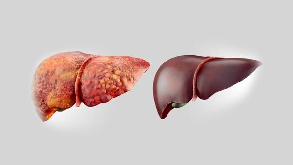 بیماری کبدی کودکان خطر ابتلا به دیابت نوع ۲ را افزایش می دهد بیماری کبدی کودکان خطر ابتلا به دیابت نوع ۲ را افزایش می دهد
