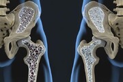 افزایش خطر بروز پوکی استخوان پس از ۵۰ سالگی