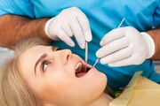 افزایش سه برابری آمار پوسیدگی دندان در ایران