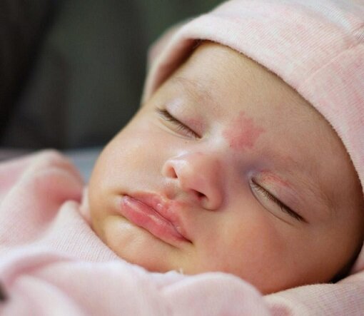 لکه های سالمون