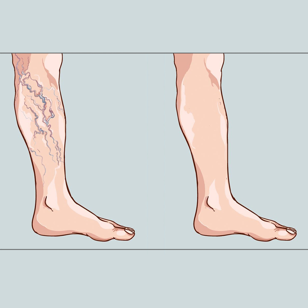 درمان واریس پا با 5 راهکار