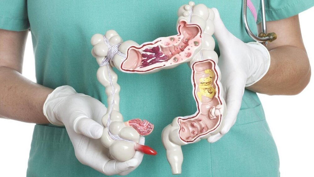 هزینههای بیحساب و کتاب غربالگری سرطان های گوارشی  هزینههای بیحساب و کتاب غربالگری سرطان های گوارشی